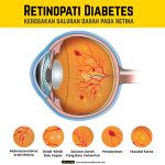 Bahaya Komplikasi Diabetes Pada Mata Retinopati Ancaman Tersembunyi Yang Mengancam Penglihatan