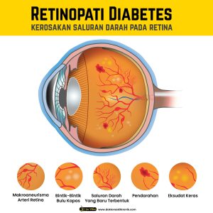 Bahaya Komplikasi Diabetes Pada Mata Retinopati Ancaman Tersembunyi Yang Mengancam Penglihatan
