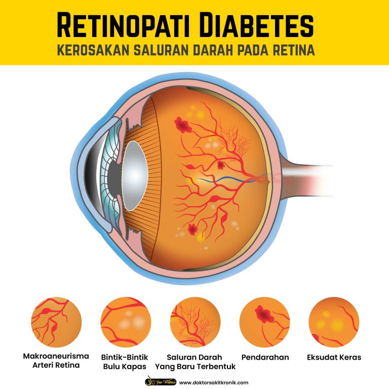 Bahaya Komplikasi Diabetes Pada Mata Retinopati Ancaman Tersembunyi Yang Mengancam Penglihatan