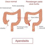 Gejala Usus Buntu Yang Mengharuskan Operasi Tanda Tanda Kritis Yang Tidak Boleh Diabaikan