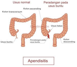 Gejala Usus Buntu Yang Mengharuskan Operasi Tanda Tanda Kritis Yang Tidak Boleh Diabaikan