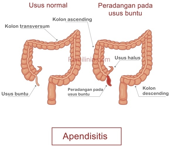 Gejala Usus Buntu Yang Mengharuskan Operasi Tanda Tanda Kritis Yang Tidak Boleh Diabaikan